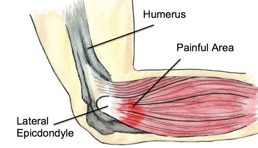 Tennis Elbow Exercises at Home