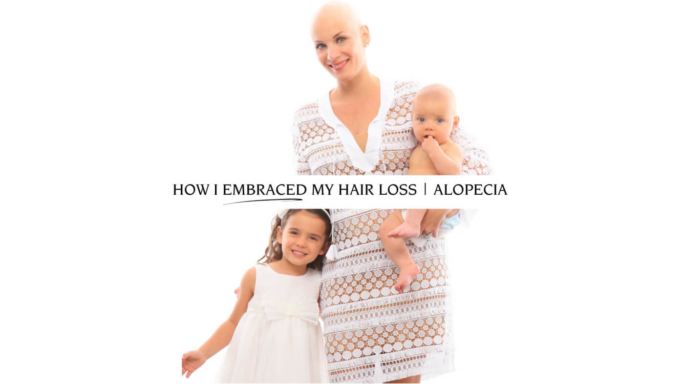 How I Embraced My Hair Loss | Alopecia