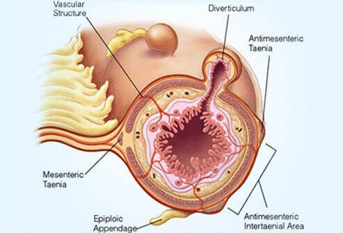 Manuka Honey & Diverticulitis