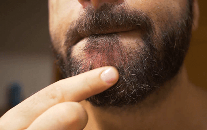 Dry Skin Under Beards - How To Get Rid Of Beard Dandruff