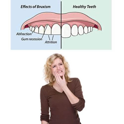 What are the signs and symptoms of teeth grinding?