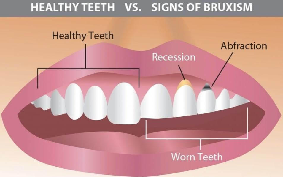 How do I stop grinding my teeth?