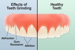 Long-Term Consequences Of Untreated Teeth Grinding