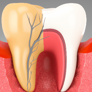 How to Tell if Your Teeth Grinding is Causing Dentin Sensitivity