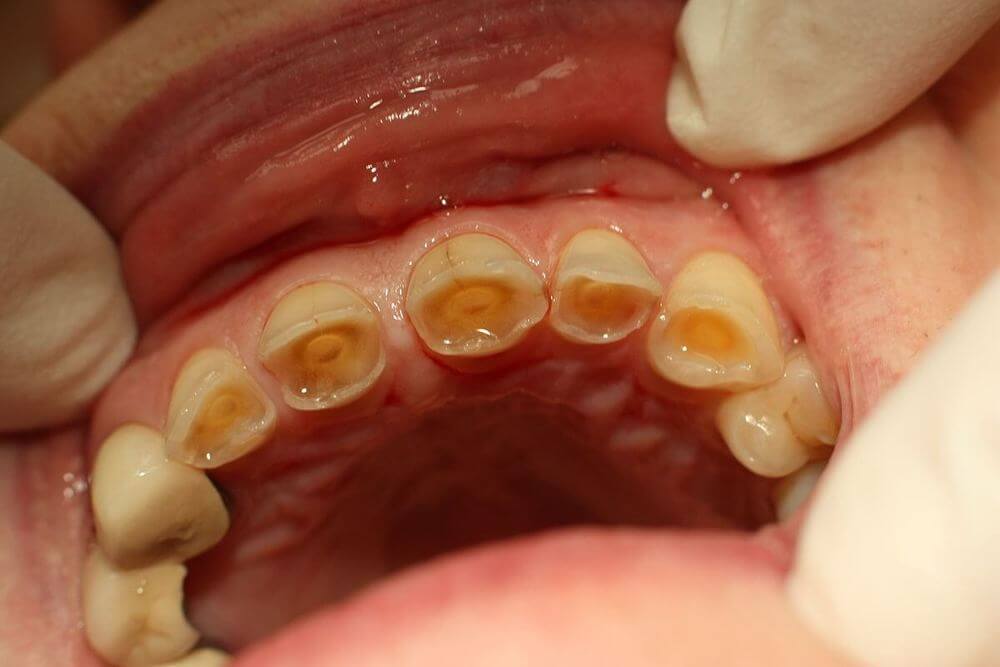 Restore Tooth Enamel | Penn Dental Family Practice