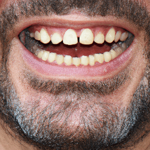 Why are my teeth getting smaller as I age?