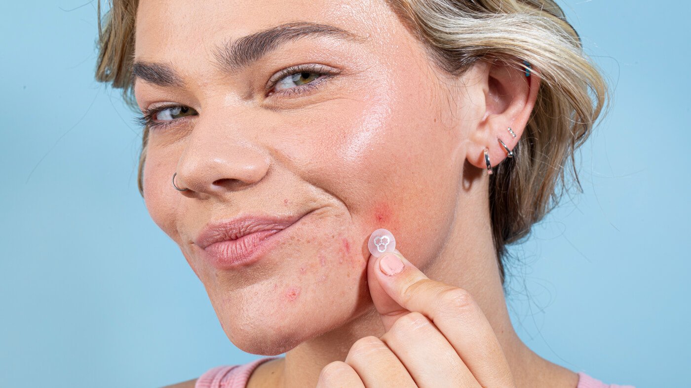 Why you shouldn’t dry out your pimples