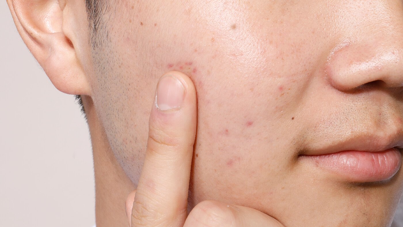 5 Things not to do when you have acne