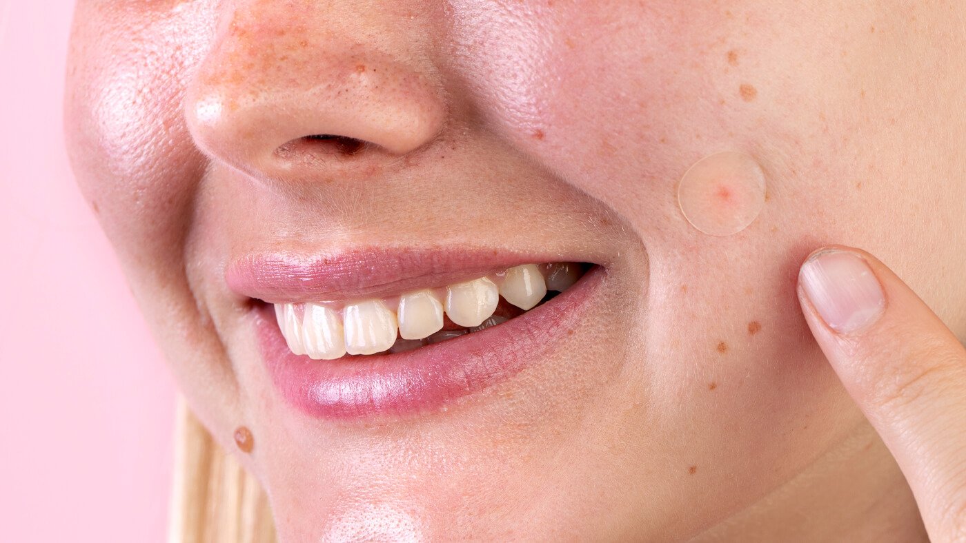 How to treat sensitive skin with acne