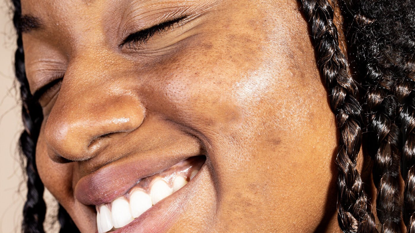 Tips to avoid post-inflammatory hyperpigmentation