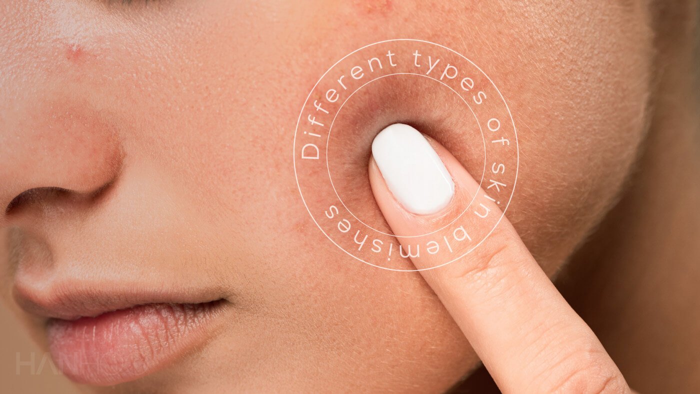 What type of blemishes do I have?