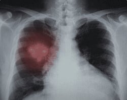 Lung +Borikiki Battled By Resveratrol and Curcumin Combo