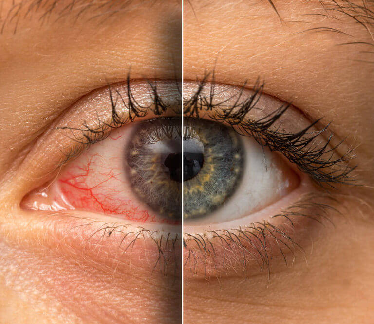 Can You Sunburn Your Eyes Understanding And Preventing It Just Human
