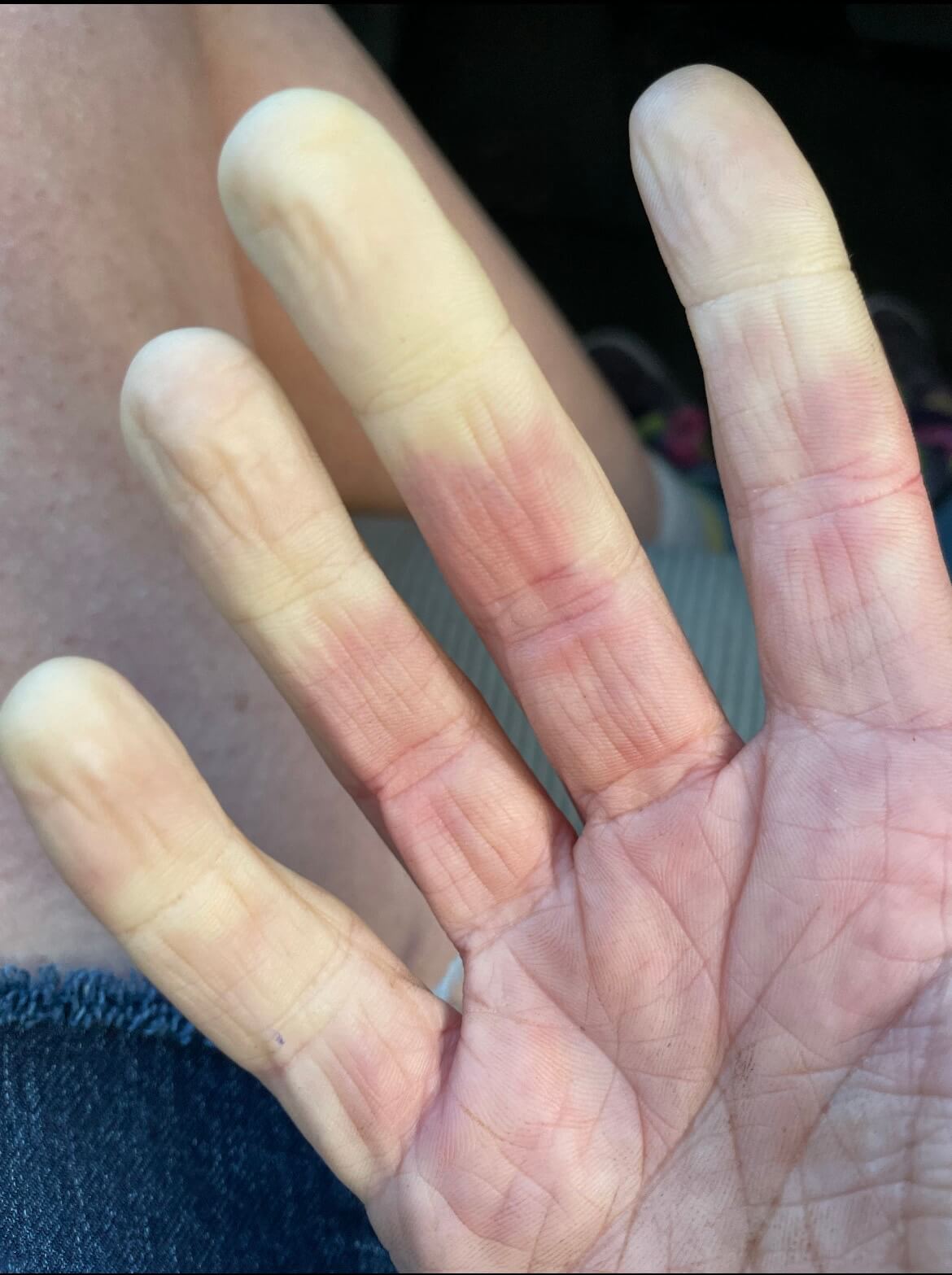 Cold Hands with Raynaud's Syndrome picture of white fingertips