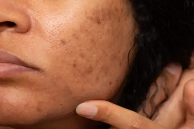 Does Hyperpigmentation Go Away?