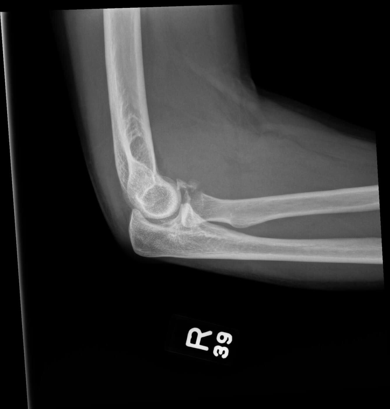 What is an XRay Marker used for? Remarkable Markers