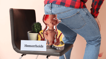 Internal Hemorrhoid Swelling After Bowel Movement: Causes and Remedies