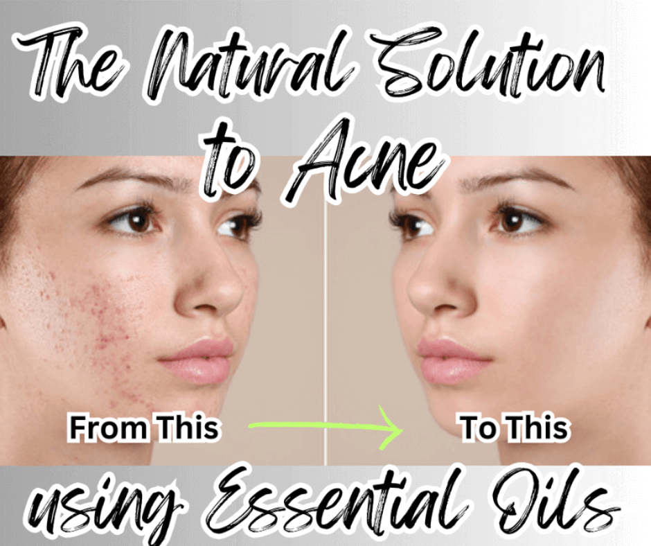 Essential Oils For Acne: Natural Solution