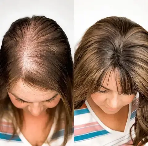 A photo of Lacie Rodriguez's hair loss before and after.