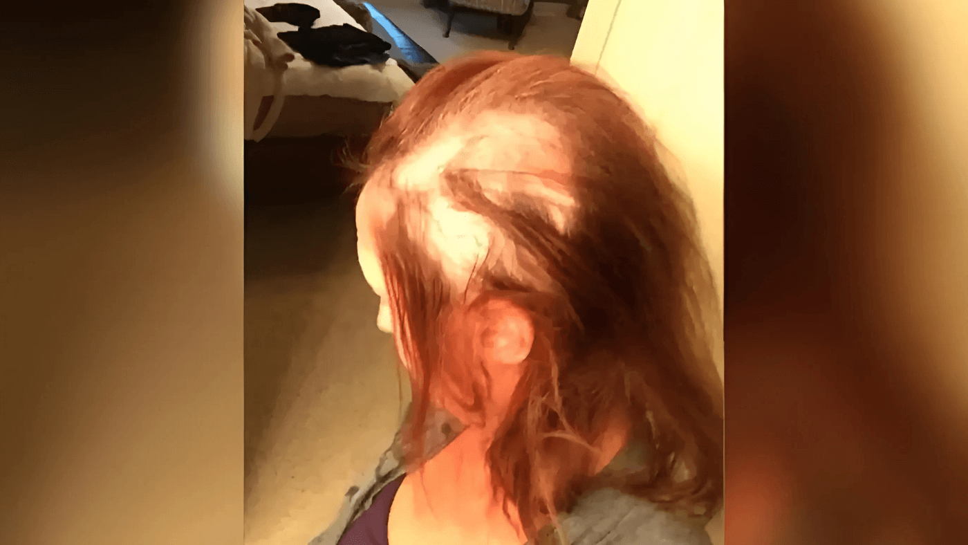 Sondra's bald spots