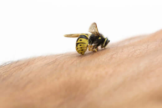 How to Treat a Bee Sting (and When to Seek Help)