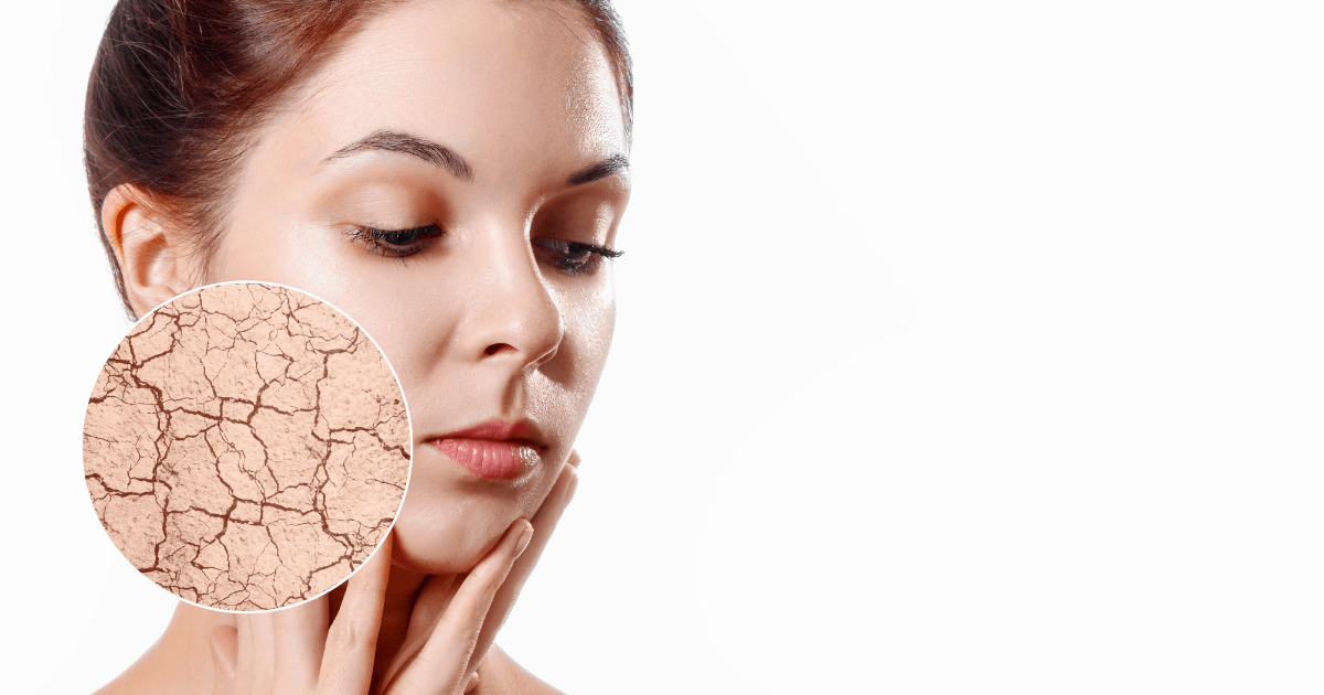 Embrace Hydration: A Guide to Combatting Dry Skin