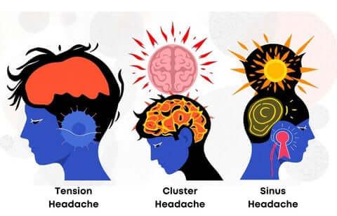 Illustration comparing tension, cluster, and sinus headache types.