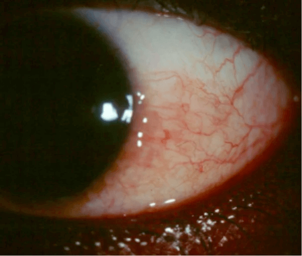 Latisse Side Effects conjunctival hyperemia