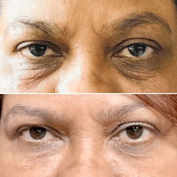 Latisse Side Effects periorbital hyperpigmentation