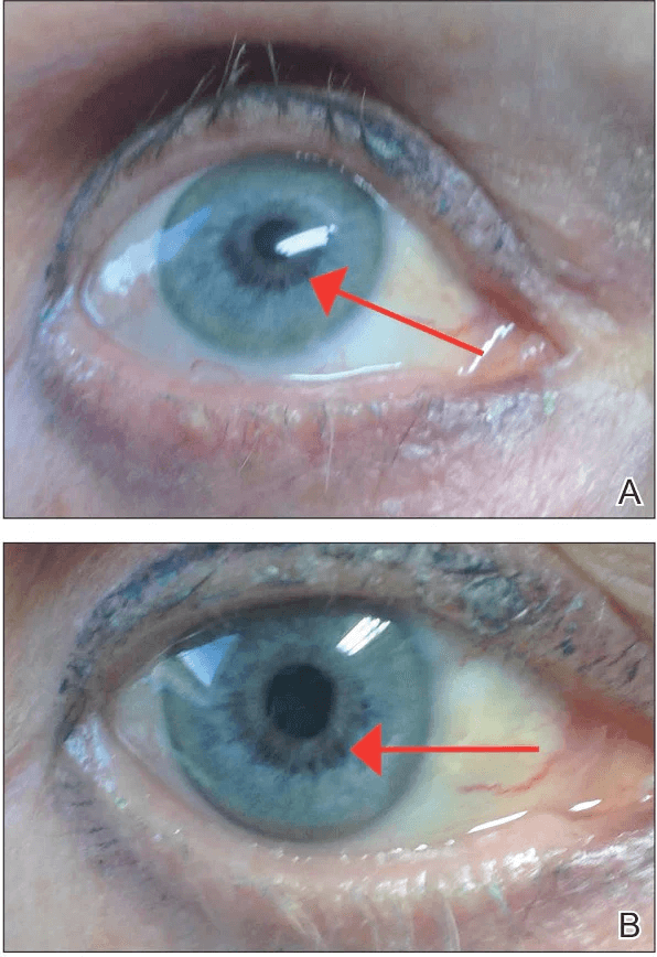 Latisse Side Effects Iris Hyperpigmentation
