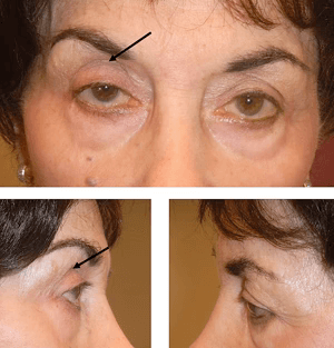 Latisse Side Effects Periorbital Fat Loss