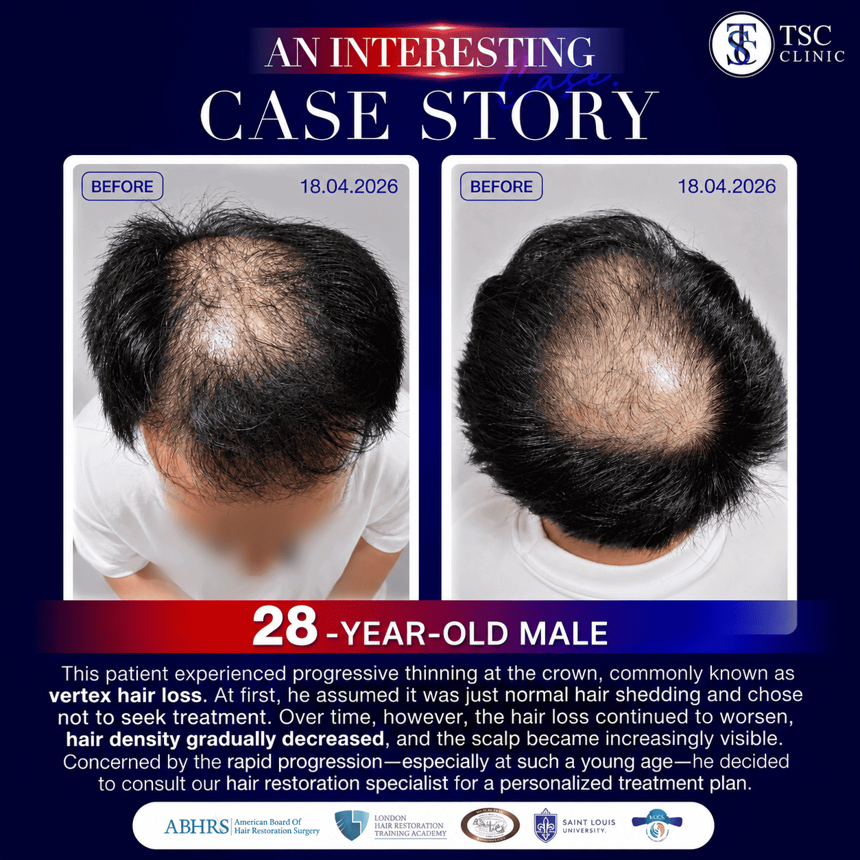  FRM Anti-Hair Loss Hair
