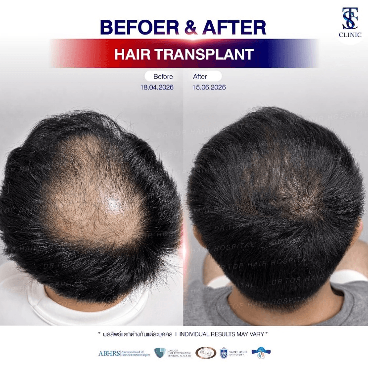  FRM Anti-Hair Loss Hair