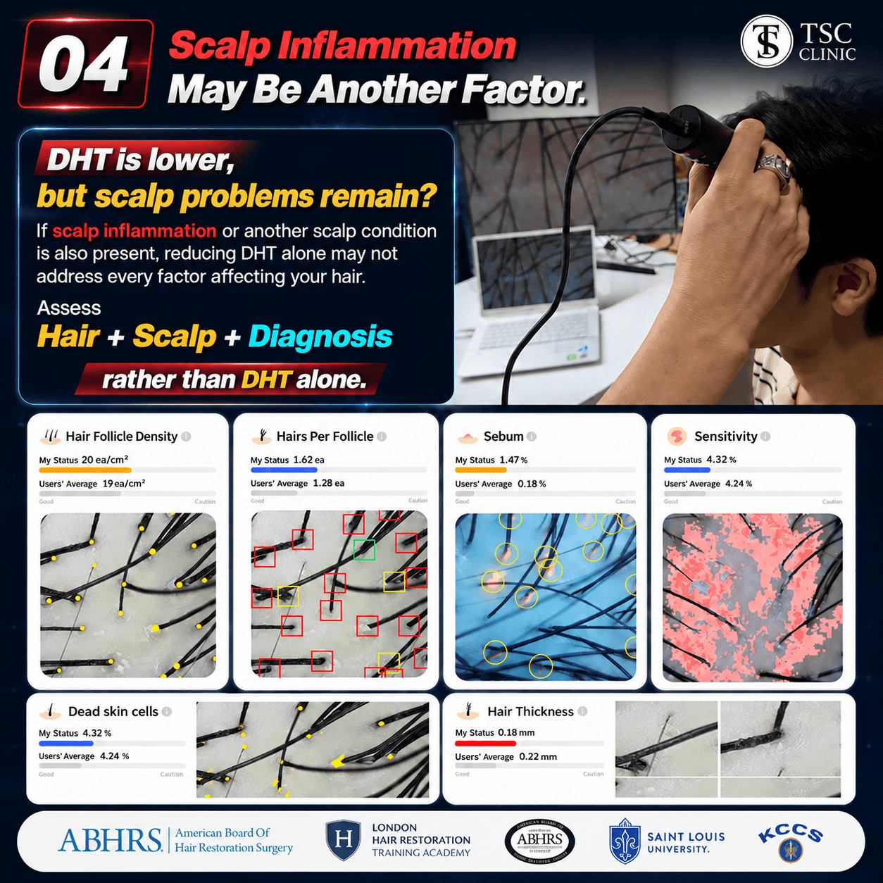 Scalp Inflammation May Be Another Factor.
