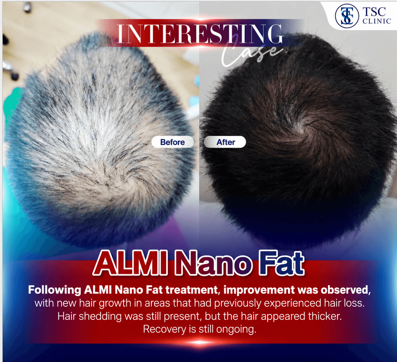 Following ALMI Nano Fat treatment, improvement was observed, with new hair growth in areas that had previously experienced hair loss. Hair shedding was still present, but the hair appeared thicker. Recovery is still ongoing.