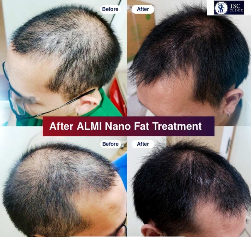 Before and After ALMI Nano Fat Treatment