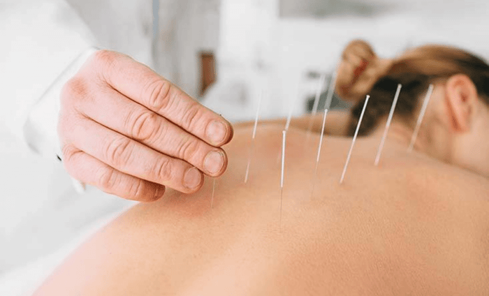 Acupuncture at Home