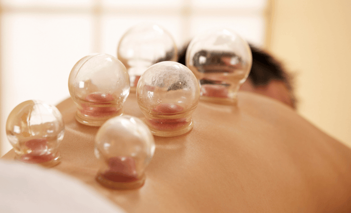 Benefits of Cupping Therapy