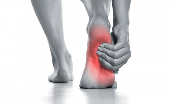 Kneading for Plantar Fasciitis