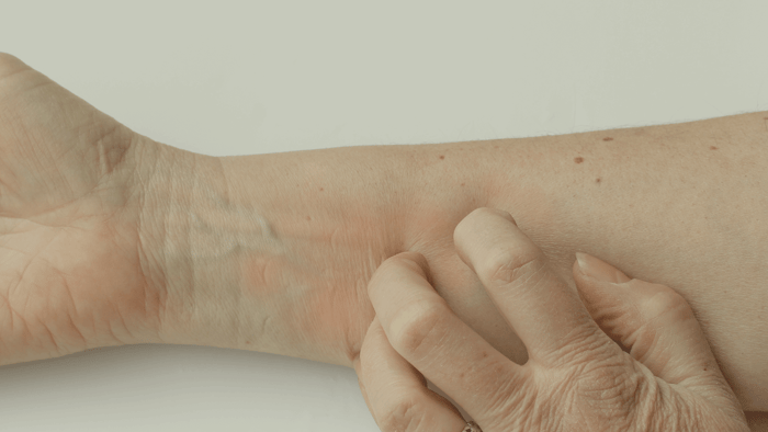 Is skin cancer itchy?