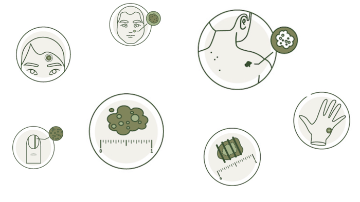 What biopsy technique should I use? Exploring Shave Biospies vs. Punch Biopsies vs. Excisions