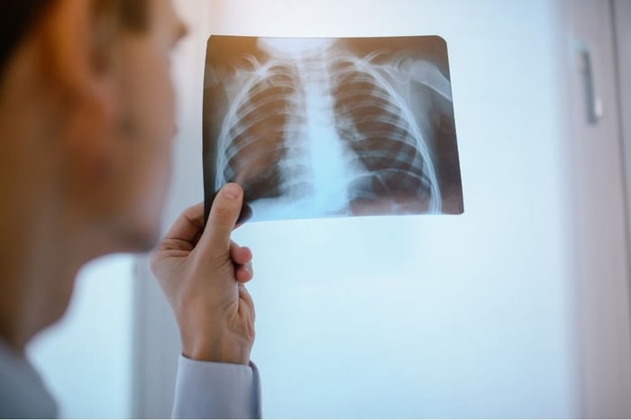 Manuka Honey and Amikacin: A Powerful Combo Against Lung Infections