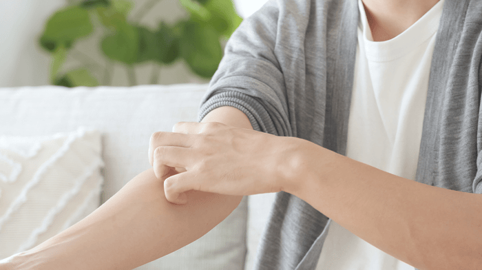 Hautkrankheit: Wie du ein atopisches Ekzem behandeln kannst