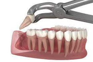 Understanding the Causes and Solutions for Grinding Teeth after Wisdom Teeth Removal