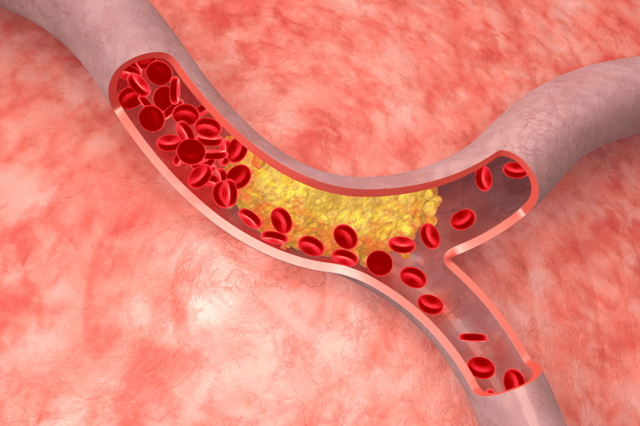 Jo lavere kolesterol – jo lavere risiko for nyt slagtilfælde