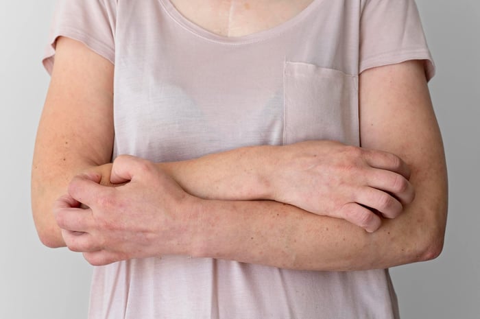 Mere salt = mere eksem? Studie kobler natrium til atopisk dermatitis