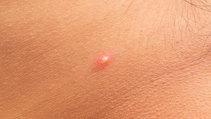 Which Pimples Are Safe To Pop and Which Aren't?