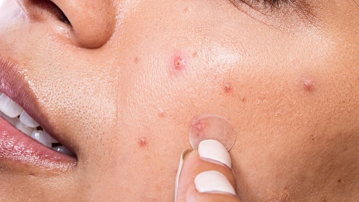 Does Eating Junk Food Really Cause Acne?