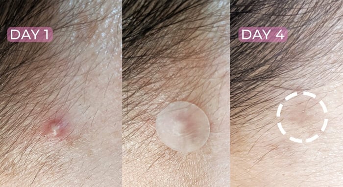 Why should I add hydrocolloid patches to my skincare routine?