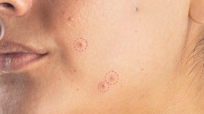 What do you do if a pimple starts bleeding?